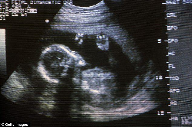 गर्भ में पल रहे बच्चे के लिंग का पता लगाना गैर-क़ानूनी है